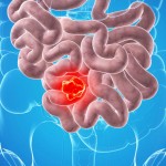 landscape-1445712673-g-bowel-cancer-513088955